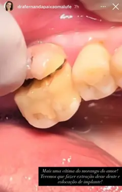 Dente parcialmente quebrado na boca de um paciente
