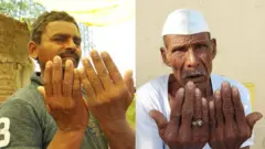 बुलडाणा नखगळतीचे रुग्ण 