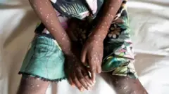 Илдет Африкада эле эмес, башка мамлекеттерде да аныкталууда