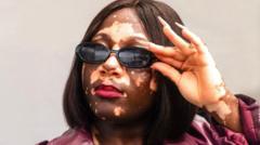 'Embrace us, make society no look us different' - Young Ghanaian vitiligo model and activist preach against stigma