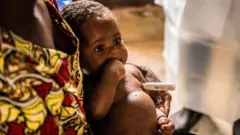 በዝንጀሮ ፈንጣጣ የተያዘ ህጻን