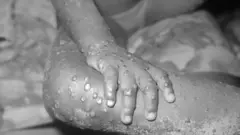 Aworan Monkeypox