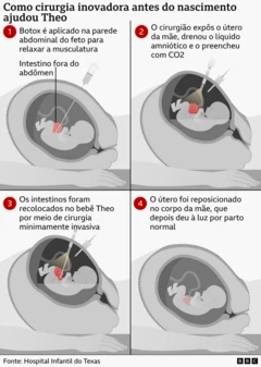 Infográfico que mostra uma cirurgia pré-natal em quatro etapas. O feto recebe uma injeção de botox na parede abdominal para relaxar os músculos. Em seguida, os cirurgiões abrem temporariamente o útero e, por meio de uma cirurgia minimamente invasiva, recolocam os intestinos do feto no abdômen. Depois, o útero é reposicionado, permitindo que a gestação continue até o nascimento do bebê, por parto normal