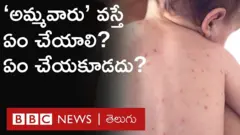 ఆటలమ్మ, అమ్మవారు వస్తే ఎలాంటి జాగ్రత్తలు తీసుకోవాలి?