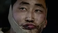 턱에 붕대를 감고 있는 북한군 추정 병사의 얼굴