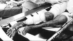 burn victim