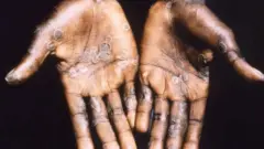 Ibimenyetso bya monkeypox birimo nko kugira uburyaryate butera kwishimashima hamwe no kubabuka umubiri cyane cyane ku birenge no ku biganza
