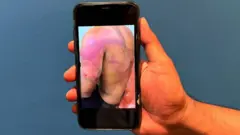 The bruise marks on a tortured man from Sri Lanka.