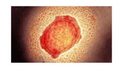 جدري القرود