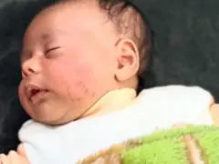 تخشى الأم من أن تترك هذه الندبات تشوها في وجه صغيرها تذكّره بالواقعة طوال العمر