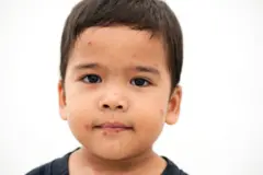 ઓરીના ગંભીર મામલા, ઓરી, અછબડાં, બાળક, સ્વાસ્થ્ય, બીબીસી ગુજરાતી 