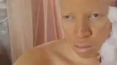 "Living with Albinism" Around 5...9