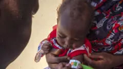 O braço de uma criança refugiada sudanesa que sofre de desnutrição é examinado por um médico no hospital criado pela ONG Médicos Sem Fronteiras (MSF).