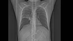 Des radiographies, des tomographies et des biopsies sont utilisées pour diagnostiquer la maladie