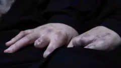 As mãos de Nayfe estão apoiadas em seu colo, uma delas tem dois dedos quase completamente faltando, enquanto a outra parece não ter mais dedos