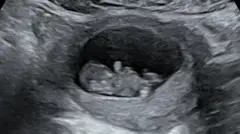 Um ultrassom fetal com imagem em preto e branco