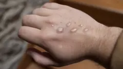 Cacar monyet yang bisa membuat kulit ruam dan melepuh.