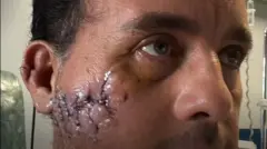 Rosto de homem com marcas de mordida cicatrizadas