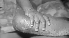 Picture wey show person wey monkey pox