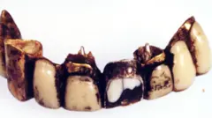 照片显示一排专家相信是纳粹德国独裁者遗骸的颚骨连牙齿，这张照片在俄罗斯莫斯科展出（2000年4月）