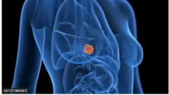 Aworan ọmu to ni apẹẹrẹ jẹjẹrẹ.