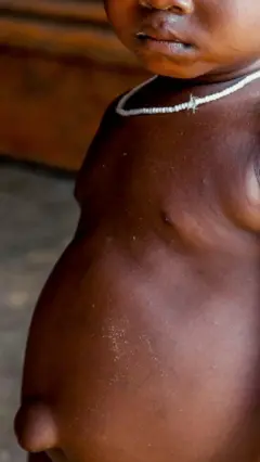 Ihe i kwesịrị ịma gbasara ọrịa apa afọ na-egbu ụmụaka