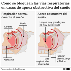 Chart illustrating normal breathing and sleep apnea.