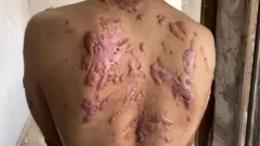 La espalda de Mohammad Abu Tawileh, cubierta de verdugones rojos.