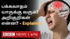 கருவில் இருக்கும் குழந்தையை கூட பக்கவாதம் பாதிக்குமா?