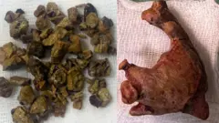 dhagxaanta ku beerma kiliyaha iyo kaadimareenka