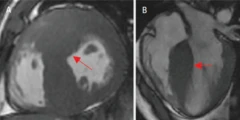 Duas imagens de ressonância magnética cardíaca comparando um coração saudável de atleta com um coração com miocardiopatia hipertrófica, mostrando a parede muscular do ventrículo esquerdo visivelmente mais espessa no primeiro caso.