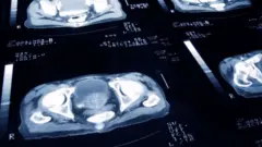 Le cancer de la prostate est le quatrième cancer le plus souffert dans le monde, selon l'American Society of Clinical Oncology.