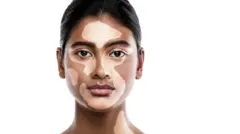 விட்டிலிகோ- வெண்புள்ளி