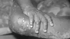 मंकीपॉक्स