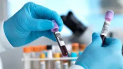 Le test, appelé Galleri, a détecté correctement deux cancers sur trois chez 5 000 personnes.