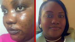 Hyperpigmentation : Comment je m'en suis débarrassée, Lina Marguerite Ndiaye