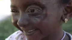 عين جديدة للطفلة اليمنية عمرها 6 أعوام