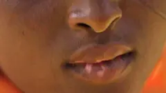 Los labios de una las hijas de Fátima, donde se ve la decoloración irregular.