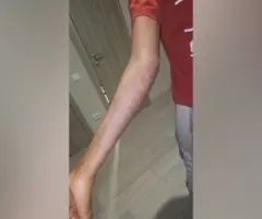 Pessoa estende o braço, com uma grande área de descoloração na pele.