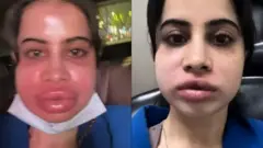 عرفی جاوید نے ہنٹوں کو نمایاں کرنے کے لیے فلر کروائے تھے