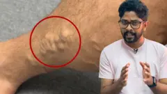 වෙරිකෝස් කියන්නේ මොකක් ද?