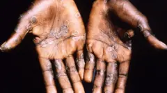 Picture of pesin wey get monkeypox