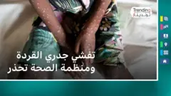 جدري القردة