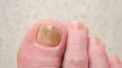 Foto de um pé com a unha do dedão escura.