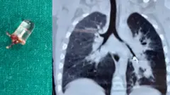 3 वर्षाच्या मुलाच्या फुप्फुसातून काढला LED बल्ब; मुलांनी नाणी, बॅटरी, चुंबक गिळल्यास काय करायचं? वाचा
#बालआरोग्य #BBCमराठी #LEDबल्ब #ChildSafety #HealthAwareness #पॅरेंटिंग #EmergencyCare