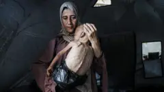 طفل مصاب بالهزال بسبب الجوع في غزة