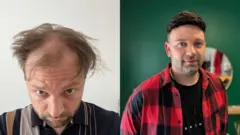 Luke Shepherd antes y después de hacerse una prótesis capilar