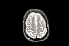 Un escaneo cerebral que muestra la enfermedad temprana de Alzhéimer. La imagen del cerebro es blanca sobre un fondo negro