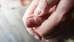 Foto de duas mãos com os cantos ressecados.