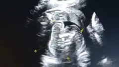 सोनोग्राफी केल्यानंतर महिलेच्या पोटातील बाळाच्या पोटातही बाळ असल्याचं दिसून आलं.